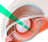 Возможна ли повторная замена искусственного хрусталика глаза?