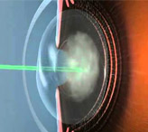 Лазерная дисцизия вторичной катаракты