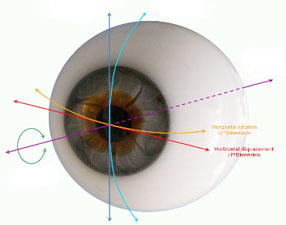 Астигматизм глаз лазерное лечение thumbnail