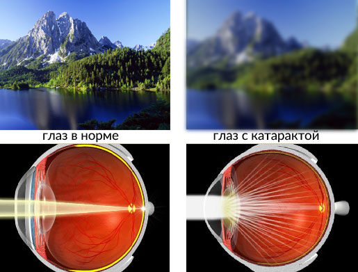 Как видит человек с начальной катарактой