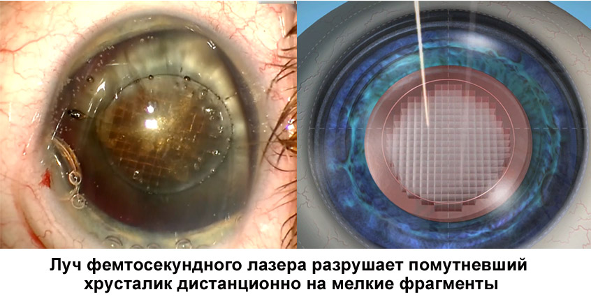удаление катаракты лазером