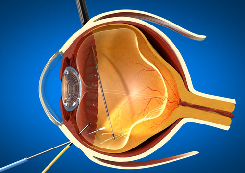 retina viktterktom