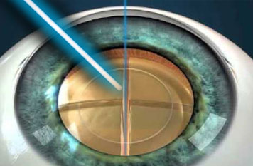 Фемтосекудное удаление катаракты