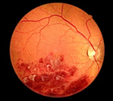 Тромбоз вен и сосудов сетчатки глаза: основные симптомы и методы лечения