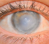 Повреждение роговицы глаза: лечение и возможные последствия