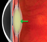 Причины возникновения катаракты