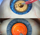 Чем отличается катаракта от глаукомы?