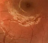 Эпиретинальный фиброз глаза