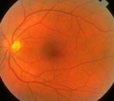 Операции на сетчатке глаза: особенности послеоперационного периода