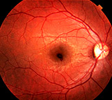 Макулодистрофия сетчатки глаза: особенности лечения