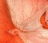 Атрофия сетчатки глаза: причины и методы лечения