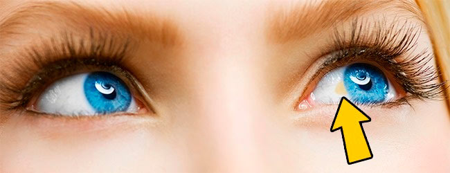 Желтые пятна на глазном белке: причины и лечение