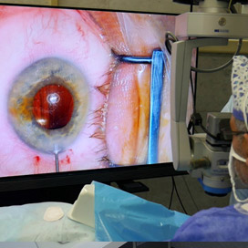 Система 3D визуализации при удалении катаракты Alcon NGENUITY