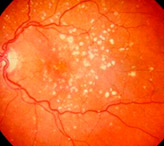 Флебопатия сетчатки глаз: что это, симптомы и методы лечения