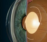 Сколько длится операция по замене хрусталика глаза