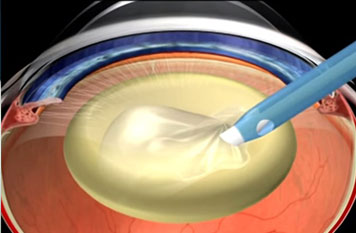 Ультразвуковая факоэмульсификация катаракты