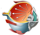 Закрытоугольная глаукома