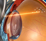 Лазерная коагуляция сетчатки глаза при беременности