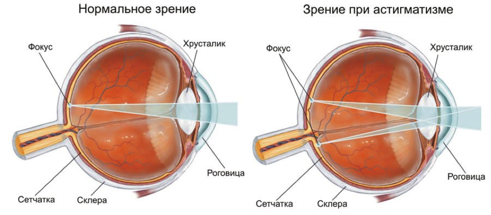 Истончение сетчатки глаза: причины и лечение